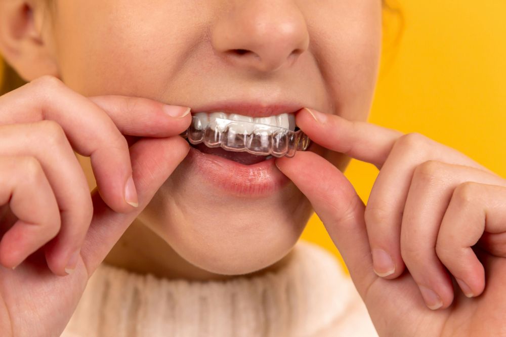 Invisalign som moderne løsning for tannregulering